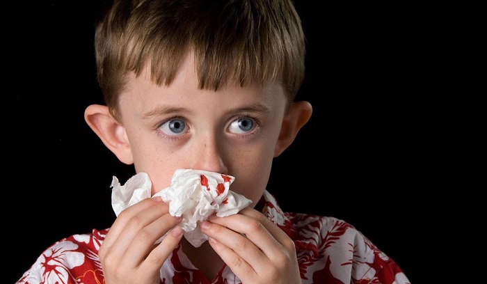 5 وصفات لعلاج نزيف الأنف عند الأطفال